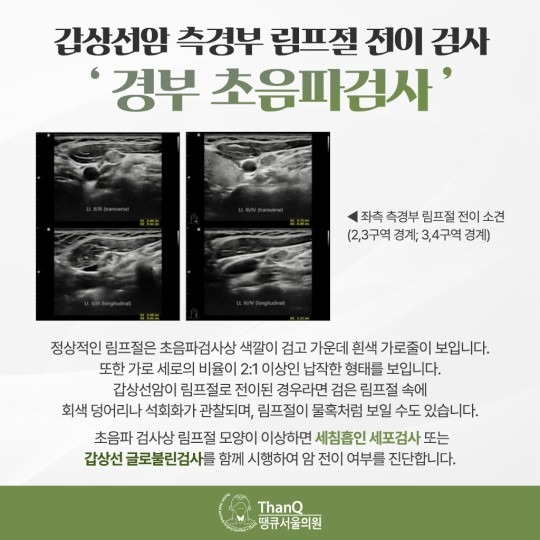 땡큐서울의원 - 갑상선암 측경부 림프절 전이