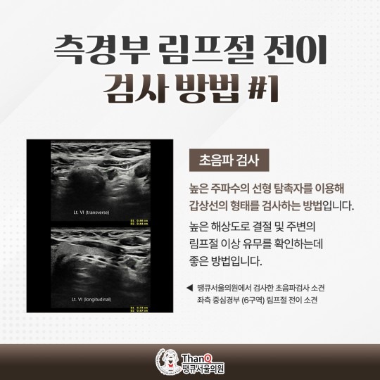 땡큐서울의원 - 측경부 림프절 절제술