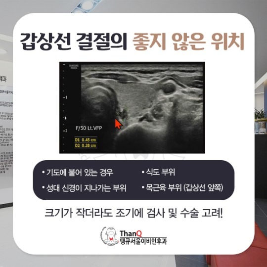 땡큐서울의원 - 작은 갑상선암