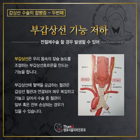 땡큐서울의원 - 갑상선수술은 얼마나 안전한가