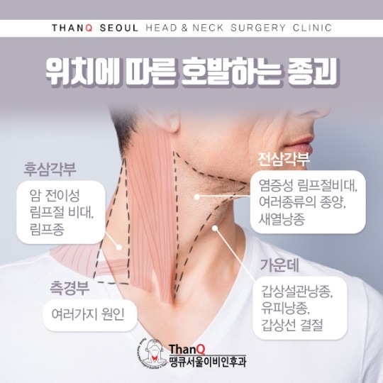 땡큐서울의원 - 목멍울